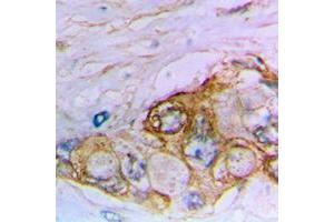 Immunohistochemical analysis of MUC16 staining in human bladder cancer formalin fixed paraffin embedded tissue section. (MUC16 抗体  (Center))