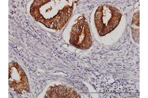 Immunoperoxidase of monoclonal antibody to SLC11A2 on formalin-fixed paraffin-embedded human endometrium cancer. (SLC11A2 抗体  (AA 1-65))