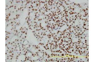 Immunoperoxidase of monoclonal antibody to ZNF143 on formalin-fixed paraffin-embedded human ovary, clear cell carcinoma tissue. (ZNF143 抗体  (AA 1-626))