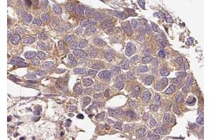 ABIN6267636 at 1/100 staining human breast carcinoma tissue sections by IHC-P.