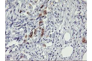 Immunohistochemical staining of paraffin-embedded Carcinoma of Human pancreas tissue using anti-SERPINB2 mouse monoclonal antibody. (SERPINB2 抗体)
