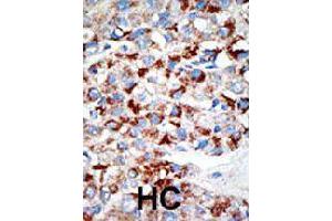 Formalin-fixed and paraffin-embedded human hepatocellular carcinoma tissue reacted with UBA3 polyclonal antibody  , which was peroxidase-conjugated to the secondary antibody, followed by DAB staining. (UBA3 抗体  (C-Term))