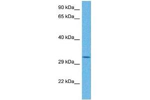 Host:  Rabbit  Target Name:  TRMT10B  Sample Tissue:  Human Stomach Tumor  Antibody Dilution:  1ug/ml (RG9MTD3 抗体  (N-Term))