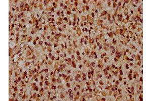 IHC image of ABIN7165222 diluted at 1:1600 and staining in paraffin-embedded human glioma performed on a Leica BondTM system.