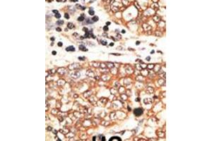 Formalin-fixed and paraffin-embedded human cancer tissue reacted with the primary antibody, which was peroxidase-conjugated to the secondary antibody, followed by AEC staining. (Neuregulin 2 抗体  (C-Term))