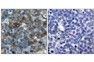 Immunohistochemical analysis of paraffin-embedded human tonsil carcinoma tissue using VASP (phospho-Ser157) antibody (E011214). (VASP 抗体  (pSer157))
