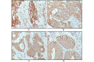 Immunohistochemical analysis of paraffin-embedded human breast carcinoma (A), hepatocarcinoma (B), stomach cancer (C) and colon cancer tissue (D), showing cytoplasmic location with DAB staining using CK18 mouse mAb. (Cytokeratin 18 抗体)