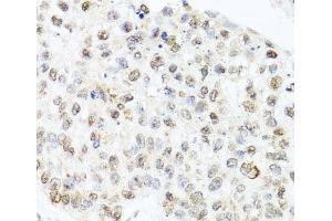 Immunohistochemistry of paraffin-embedded Human lung cancer using CETN3 Polyclonal Antibody at dilution of 1:100 (40x lens). (CETN3 抗体)