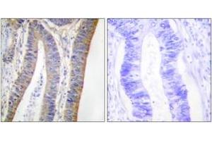 Immunohistochemistry analysis of paraffin-embedded human colon carcinoma, using p47 phox (Phospho-Ser359) Antibody. (NCF1 抗体  (pSer359))
