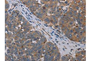 The image on the left is immunohistochemistry of paraffin-embedded Human ovarian cancer tissue using ABIN7191748(OTOR Antibody) at dilution 1/30, on the right is treated with synthetic peptide. (Otoraplin 抗体)