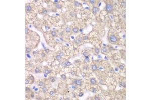 Immunohistochemistry of paraffin-embedded human liver injury using ACAT1 antibody (ABIN6292593) at dilution of 1:100 (40x lens). (ACAT1 抗体)