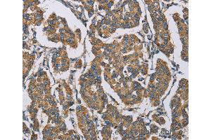 Immunohistochemistry of Human cervical cancer using HDAC6 Polyclonal Antibody at dilution of 1:50 (HDAC6 抗体)