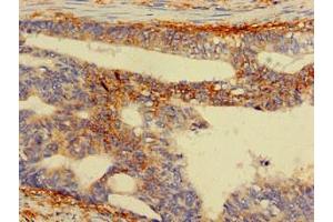 Immunohistochemistry of paraffin-embedded human colon cancer using ABIN7142563 at dilution of 1:100 (RPS5 抗体  (AA 1-204))