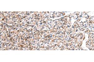 Immunohistochemistry of paraffin-embedded Human prost ate cancer tissue using DCAF7 Polyclonal Antibody at dilution of 1:30(x200) (DCAF7 抗体)
