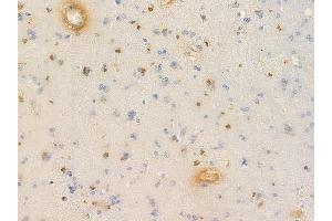 ABIN6256636 and ABIN6267635 at 1/100 staining human glioblastoma by IHC-P. (GRIN2B 抗体  (pTyr1336))