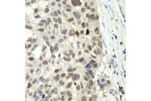 Immunohistochemistry of paraffin-embedded human esophageal cancer using E2F6 antibody. (E2F6 抗体)