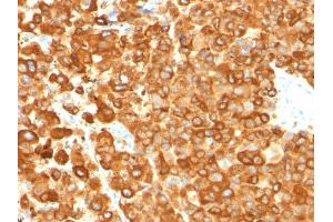 Formalin-fixed, paraffin-embedded human Melanoma stained with gp100 Mouse Monoclonal Antibody (PMEL/783). (Melanoma gp100 抗体)