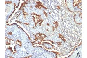 Formalin-fixed, paraffin-embedded human Lung Carcinoma stained with Cytokeratin 7 Monoclonal Antibody (KRT7/760 + OV-TL12/30) (Cytokeratin 7 抗体)