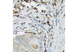 Immunohistochemistry of paraffin-embedded human colon carcinoma using TLR1 Rabbit pAb (ABIN3023654, ABIN3023655, ABIN3023656 and ABIN6214092) at dilution of 1:100 (40x lens). (TLR1 抗体  (AA 30-290))