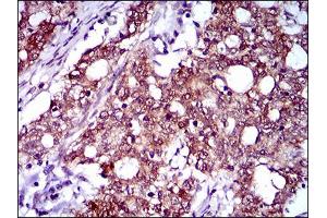 Immunohistochemical analysis of paraffin-embedded cervical cancer tissues using CFLAR mouse mAb with DAB staining. (FLIP 抗体  (AA 100-251))