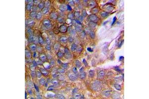Immunohistochemical analysis of MMP10 staining in human prostate cancer formalin fixed paraffin embedded tissue section. (MMP10 抗体  (C-Term))