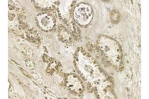 ANP32E Mouse Monoclonal Antibody at 1/100 staining human ovarian cancer by IHC-P. (ANP32E 抗体)