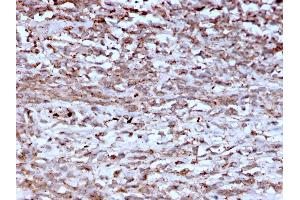 Formalin-fixed, paraffin-embedded human Hepatocellular Carcinoma stained with Cathepsin K Mouse Monoclonal Antibody (CTSK/2793). (Cathepsin K 抗体  (AA 163-274))