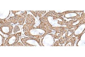 Immunohistochemistry of paraffin-embedded Human thyroid cancer tissue using RNF111 Polyclonal Antibody at dilution of 1:50(x200) (RNF111 抗体)