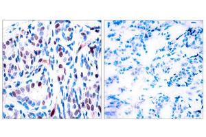 Immunohistochemistry (IHC) image for anti-Signal Transducer and Activator of Transcription 3 (Acute-Phase Response Factor) (STAT3) (pTyr705) antibody (ABIN1847535) (STAT3 抗体  (pTyr705))