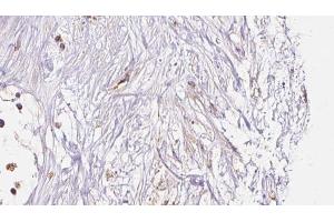 ABIN6273048 at 1/100 staining Human liver cancer tissue by IHC-P. (HLA-F 抗体)