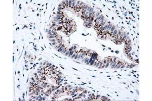 Immunohistochemical staining of paraffin-embedded Adenocarcinoma of colon tissue using anti-KIAA1609 mouse monoclonal antibody. (KIAA1609 抗体)