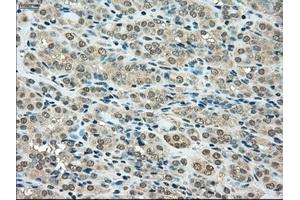Immunohistochemical staining of paraffin-embedded Carcinoma of thyroid tissue using anti-SSBmouse monoclonal antibody. (SSB 抗体)