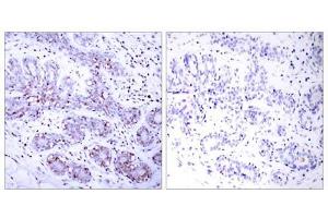 Immunohistochemical analysis of paraffin-embedded human breast carcinoma tissue using STAT4 (Ab-693) antibody (E021047). (STAT4 抗体)