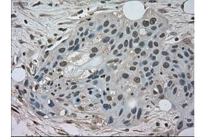 Immunohistochemical staining of paraffin-embedded Carcinoma of kidney tissue using anti-NEK6mouse monoclonal antibody. (NEK6 抗体)