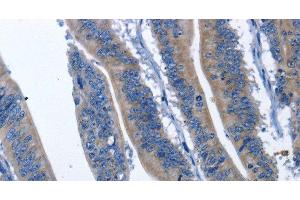 Immunohistochemistry of paraffin-embedded Human colon cancer using HSF27 Polyclonal Antibody at dilution of 1:60 (CDK5RAP3 抗体)
