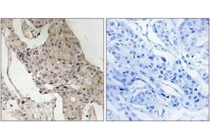 Immunohistochemistry analysis of paraffin-embedded human breast carcinoma, using Gab2 (Phospho-Ser623) Antibody. (GAB2 抗体  (pSer623))