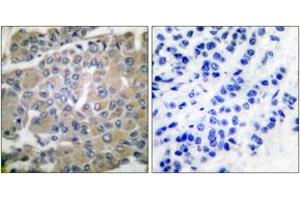 Immunohistochemistry analysis of paraffin-embedded human breast carcinoma tissue, using MMP-8 Antibody. (MMP8 抗体  (AA 418-467))