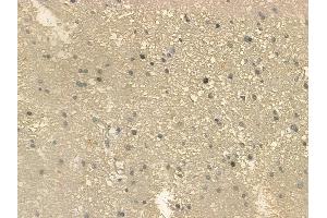 ABIN6259249 and ABIN6273986 at 1/100 staining human glioblastoma by IHC-P.