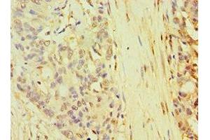 Immunohistochemistry of paraffin-embedded human endometrial cancer using ABIN7168268 at dilution of 1:100 (TARBP2 抗体  (AA 1-366))