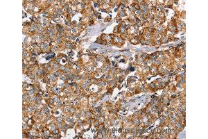 Immunohistochemistry of Human breast cancer using PPOX Polyclonal Antibody at dilution of 1:40 (PPOX 抗体)