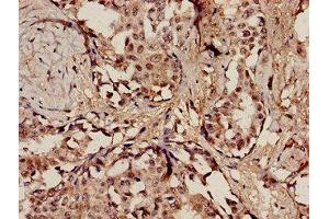 Immunohistochemistry analysis of human breast cancer using ABIN7150239 at dilution of 1:100