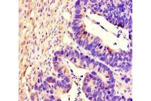 Immunohistochemistry of paraffin-embedded human ovarian cancer using ABIN7167518 at dilution of 1:100 (PTPRS 抗体  (AA 25-128))