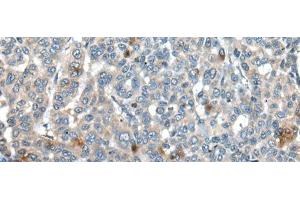 Immunohistochemistry of paraffin-embedded Human liver cancer tissue using CAPN3 Polyclonal Antibody at dilution of 1:30(x200) (Calpain 3 抗体)