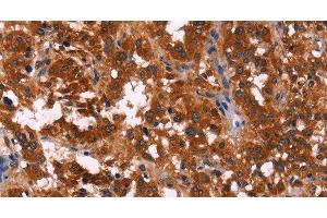 Immunohistochemistry of paraffin-embedded Human thyroid cancer using RPSA Polyclonal Antibody at dilution of 1:60 (RPSA/Laminin Receptor 抗体)