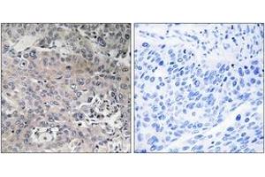 Immunohistochemistry analysis of paraffin-embedded human breast carcinoma tissue, using TUFM Antibody. (TUFM 抗体  (AA 301-350))