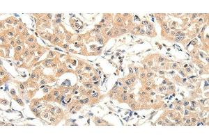 Immunohistochemistry of paraffin-embedded Human lung cancer tissue using SLC27A1 Polyclonal Antibody at dilution 1:40 (SLC27A1 抗体)
