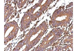 IHC-P Image Immunohistochemical analysis of paraffin-embedded human colon carcinoma, using Galectin 1, antibody at 1:500 dilution. (LGALS1/Galectin 1 抗体)