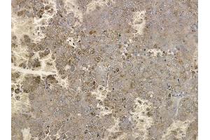 ABIN6256543 and ABIN6267175 at 1/100 staining human melanoma by IHC-P.