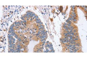 Immunohistochemistry of paraffin-embedded Human colon cancer using CD327 Polyclonal Antibody at dilution of 1:70 (SIGLEC6 抗体)