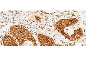 Immunohistochemistry of paraffin-embedded Human esophagus cancer tissue using POM121 Polyclonal Antibody at dilution of 1:75(x200) (POM121 抗体)